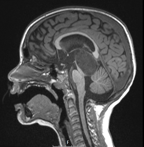 8A3 Angiocentric glioma (Case 8) T1 MPRAGE NoC Sagittal