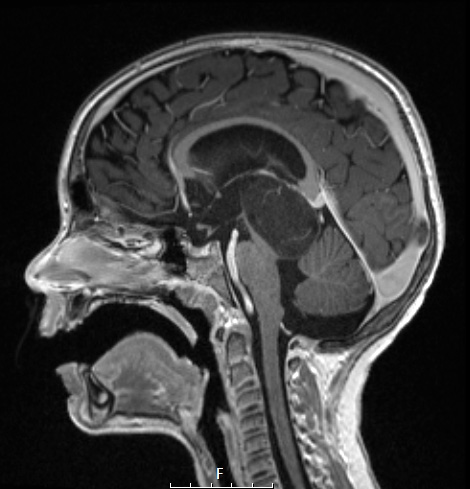 8A4 Angiocentric glioma (Case 8) T1 MPRAGE W A