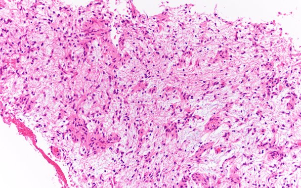8B1 Angiocentric glioma (Case 8) H&E 20X 3