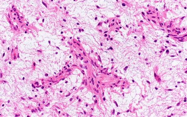 8B3 Angiocentric glioma (Case 8) H&E 40X 2