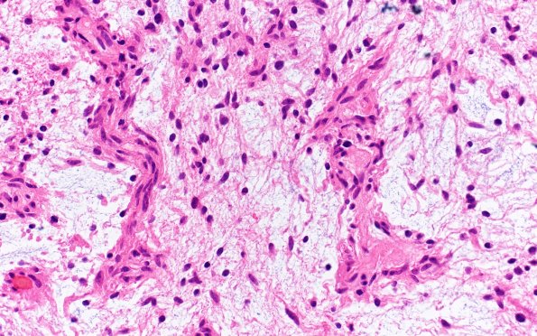 8B4 Angiocentric glioma (Case 8) H&E 40X 1