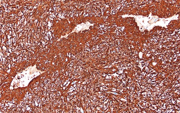 8C2 Angiocentric glioma (Case 8) GFAP 20X 2