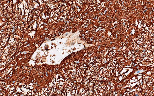 8C3 Angiocentric glioma (Case 8) GFAP 40X 3