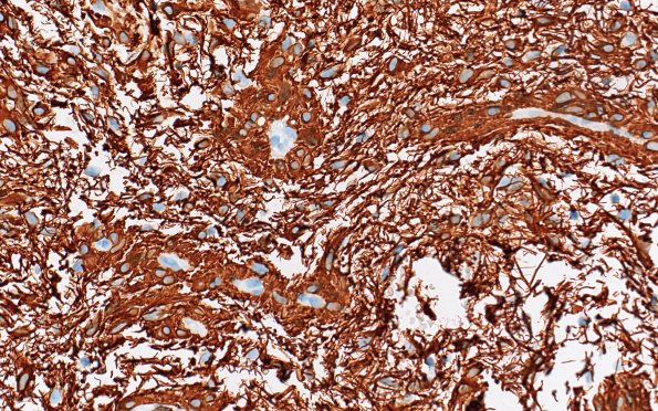 8C4 Angiocentric glioma (Case 8) GFAP 40X 4