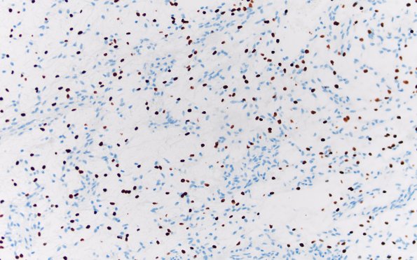8D1 Angiocentric glioma (Case 8) Olig2 20X