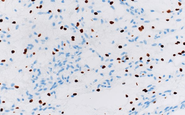 8D2 Angiocentric glioma (Case 8) Olig2 40X
