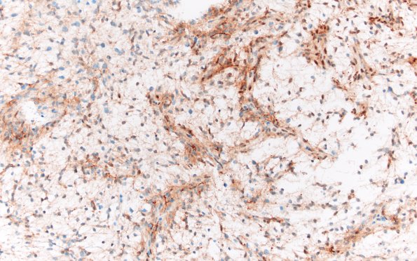 8E1 Angiocentric glioma (Case 8) D2-40 20X 3