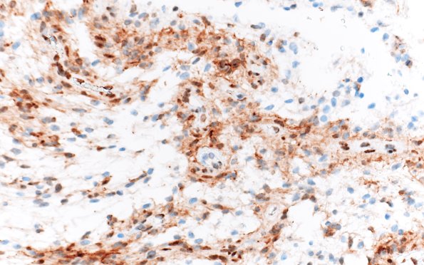 8E2 Angiocentric glioma (Case 8) D2-40 40X 2