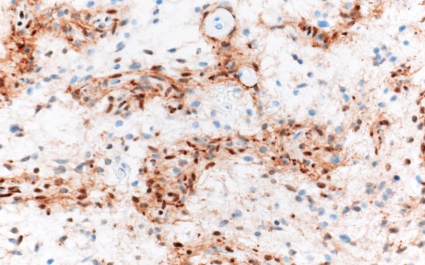 8E3 Angiocentric glioma (Case 8) D2-40 40X 6