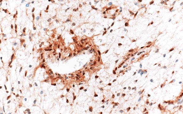 8E4 Angiocentric glioma (Case 8) D2-40 40X 7