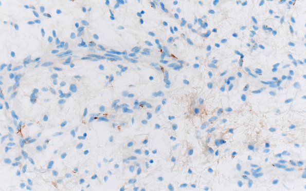 8F1 Angiocentric glioma (Case 8) EMA 40X 2