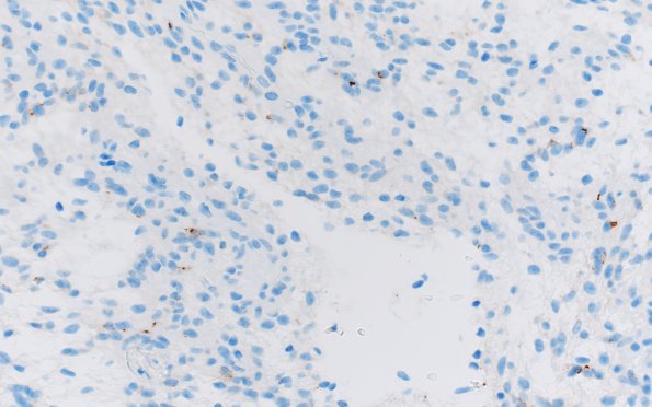 8F2 Angiocentric glioma (Case 8) EMA 40X 3