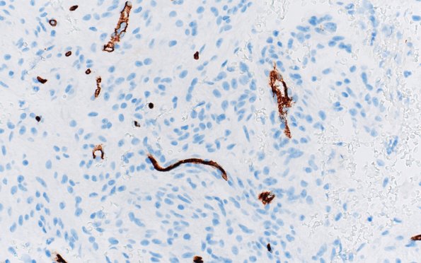 8G1 Angiocentric glioma (Case 8) CD34 40X 3