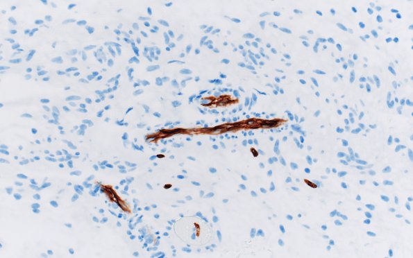 8G3 Angiocentric glioma (Case 8) CD34 40X 2