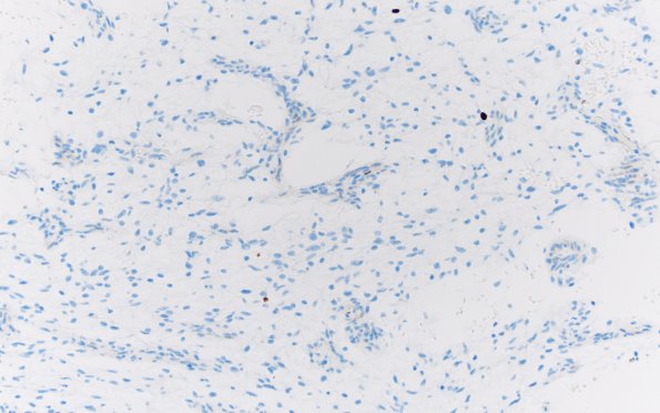 8H Angiocentric glioma (Case 8) Ki67 20X 2