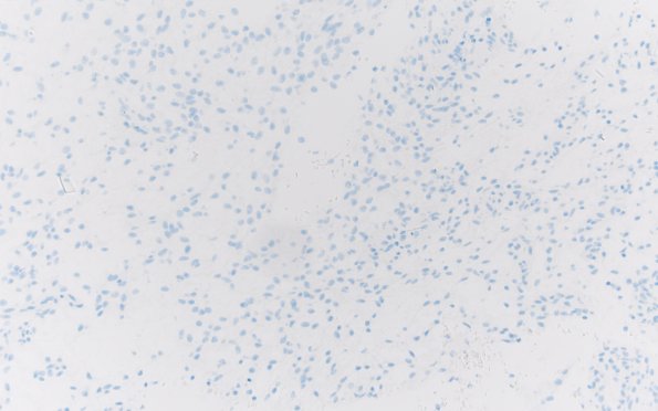 8I Angiocentric glioma (Case 8) H3K27M 20X