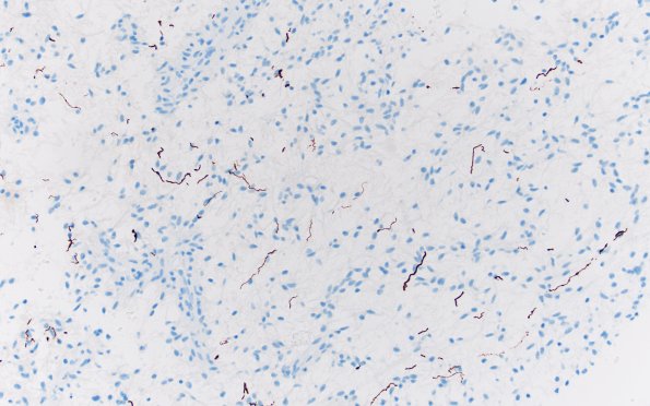 8J Angiocentric glioma (Case 8) NF 20X