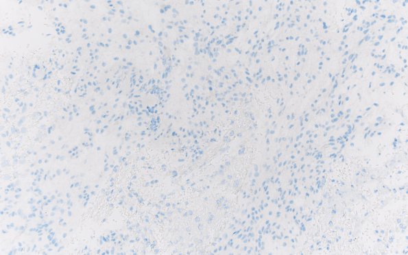 8K Angiocentric glioma (Case 8) IDH1 20X 2