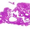 1A1 Astroblastoma, WHO II (Case 1) H&E whole mount