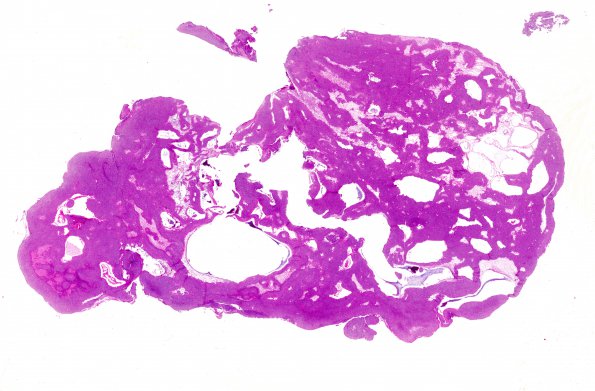 1A1 Astroblastoma, WHO II (Case 1) H&E whole mount