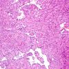 1A2 Astroblastoma, WHO II (Case 1) H&E 12.jpg