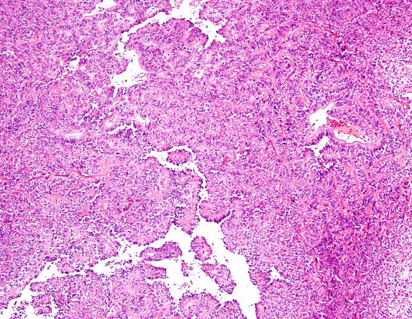 1A2 Astroblastoma, WHO II (Case 1) H&E 12.jpg