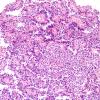 1A3 Astroblastoma, WHO II (Case 1) H&E 19.jpg