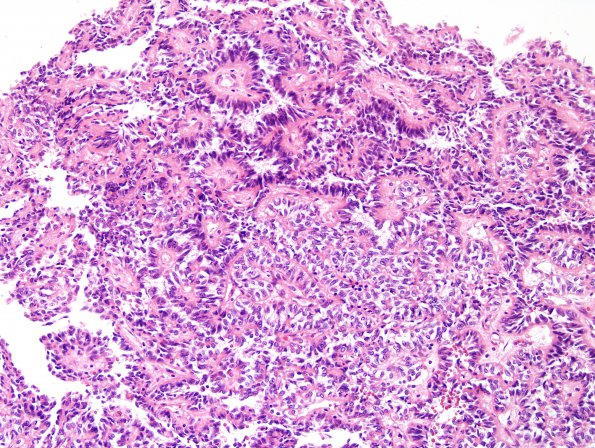 1A3 Astroblastoma, WHO II (Case 1) H&E 19.jpg