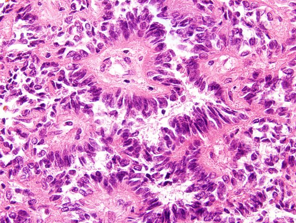 1A4 Astroblastoma, WHO II (Case 1) H&E 22.jpg