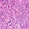 1A5 Astroblastoma, WHO II (Case 1) H&E 32.jpg