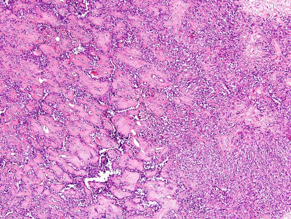 1A5 Astroblastoma, WHO II (Case 1) H&E 32.jpg