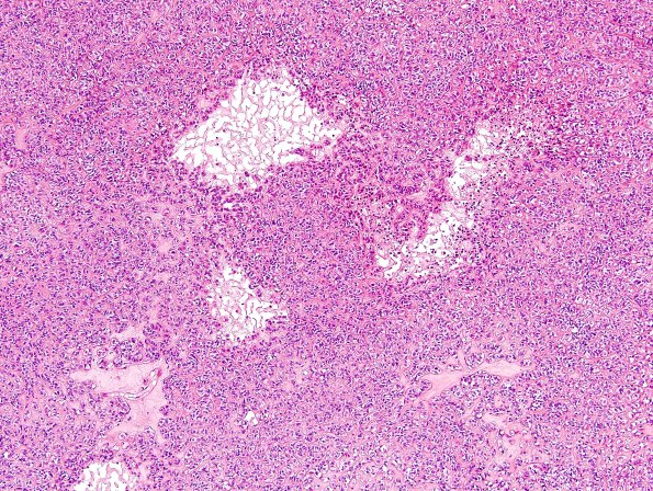 1A6 Astroblastoma, WHO II (Case 1) H&E 1.jpg