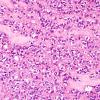 1A7 Astroblastoma, WHO II (Case 1) H&E 4.jpg