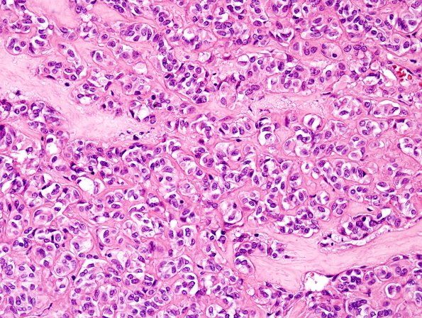 1A7 Astroblastoma, WHO II (Case 1) H&E 4.jpg