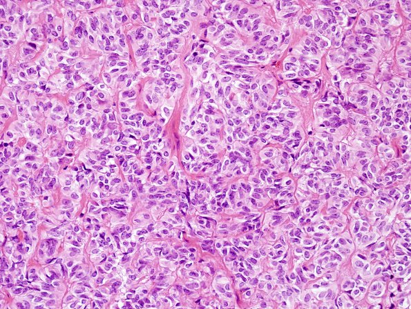 1A8 Astroblastoma, WHO II (Case 1) H&E 7.jpg