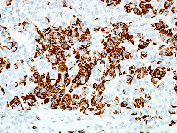 1B1 Astroblastoma, WHO II (Case 1) GFAP 10.jpg