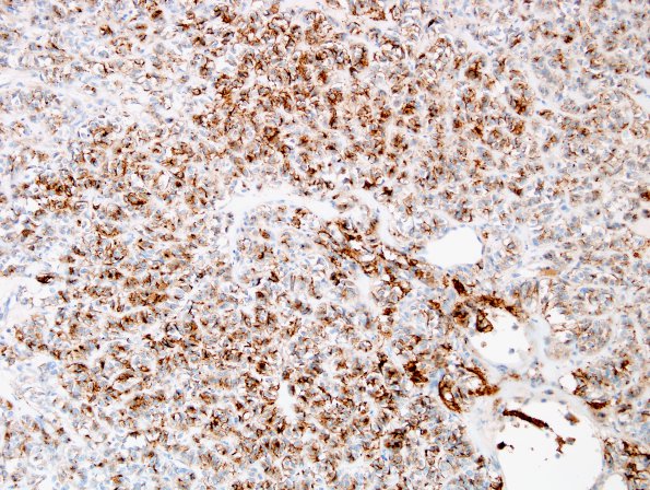 1C1 Astroblastoma, WHO II (Case 1) EMA 5.jpg