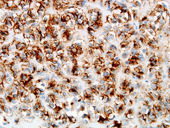 1C2 Astroblastoma, WHO II (Case 1) EMA 7.jpg