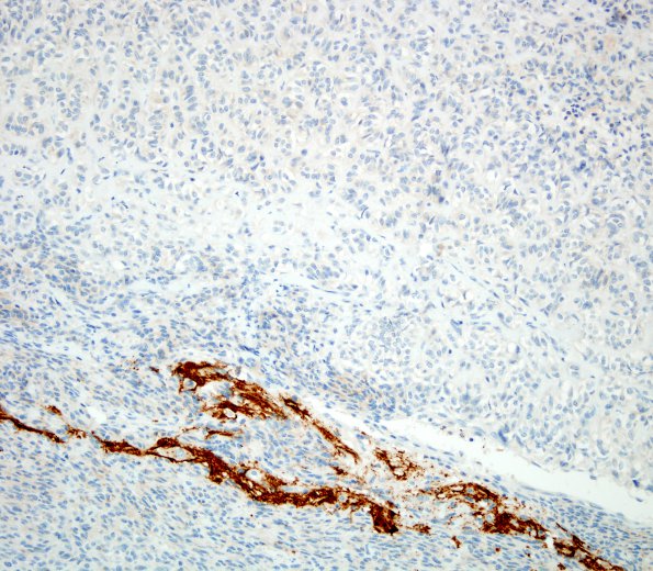 1D Astroblastoma, WHO II (Case 1) SYN 3.jpg