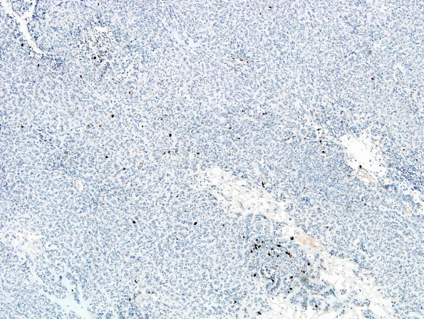 1E Astroblastoma, WHO II (Case 1) Ki67 1.jpg