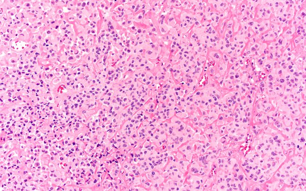 2A1 Astroblastoma, recurrent (Case 2) H&E 1