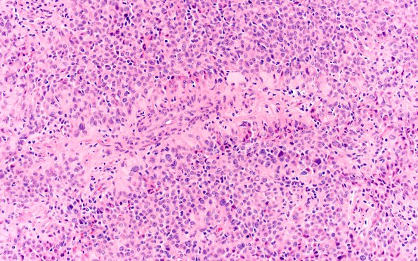 2A2 Astroblastoma, recurrent (Case 2) H&E 4