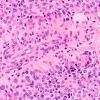 2A3 Astroblastoma, recurrent (Case 2) H&E 5