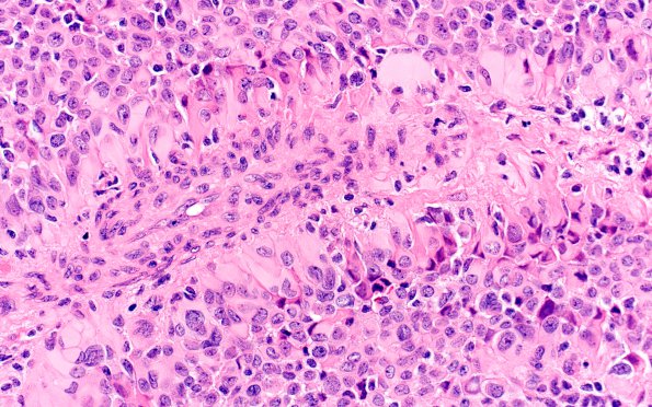 2A3 Astroblastoma, recurrent (Case 2) H&E 5