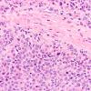 2A4 Astroblastoma, recurrent (Case 2) H&E 6