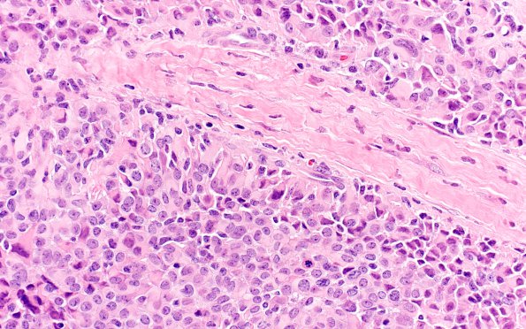 2A4 Astroblastoma, recurrent (Case 2) H&E 6