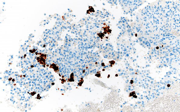 2B0 Astroblastoma, recurrent (Case 2) GFAP