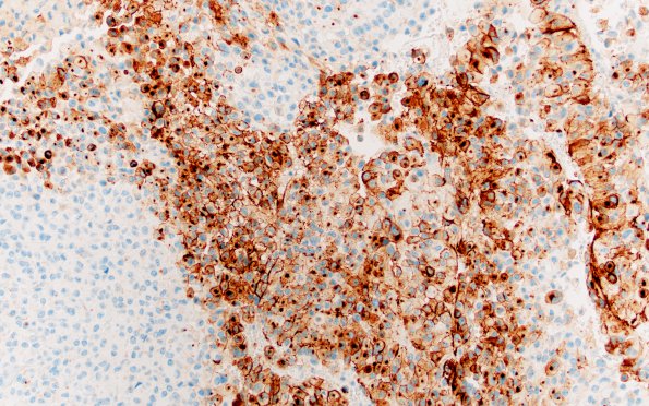 2D1 Astroblastoma, recurrent (Case 2) EMA 2