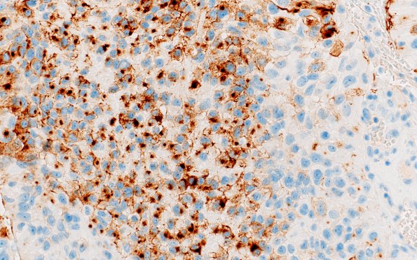 2D2 Astroblastoma, recurrent (Case 2) EMA 3