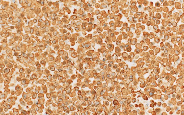 2F Astroblastoma, recurrent (Case 2) VIM 2